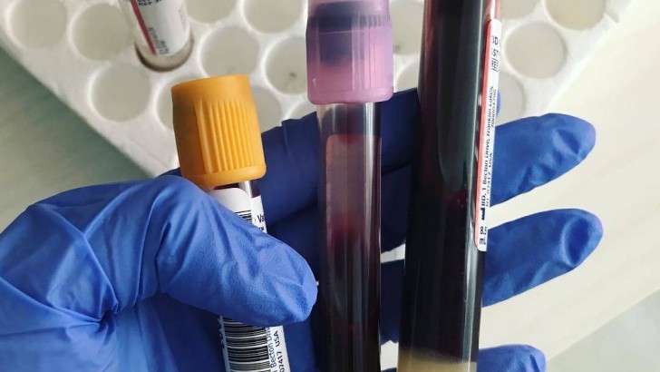 Ferritin Nedir? Düşüklüğü Ve Yüksekliği Ne Anlama Gelir?
